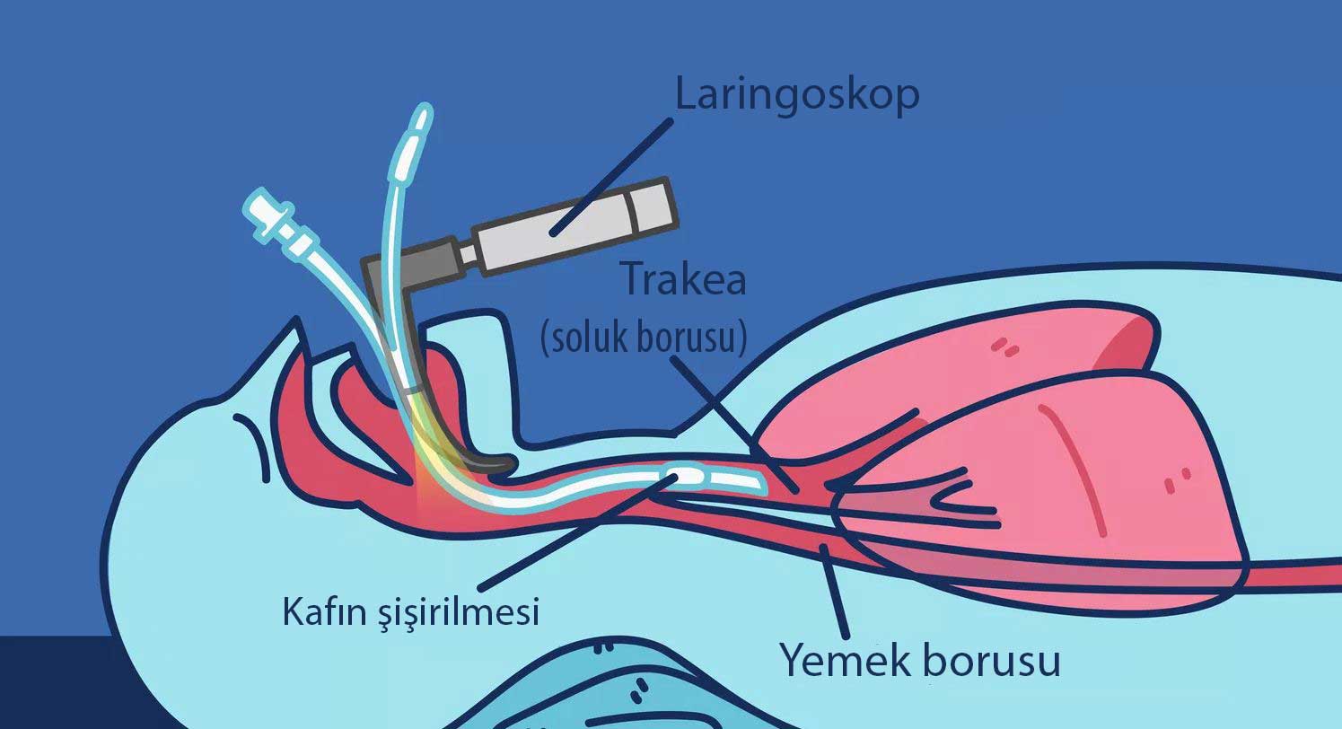 endotrakeal entübasyon nasıl yapılır