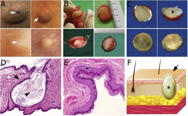 epidermoid kist nedir çeşitleri