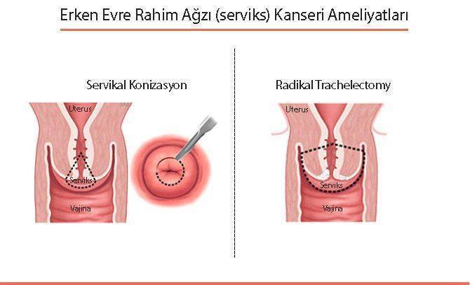 erken evre rahim ağzı kanser ameliyatı servikal konizasyon trachelectomy