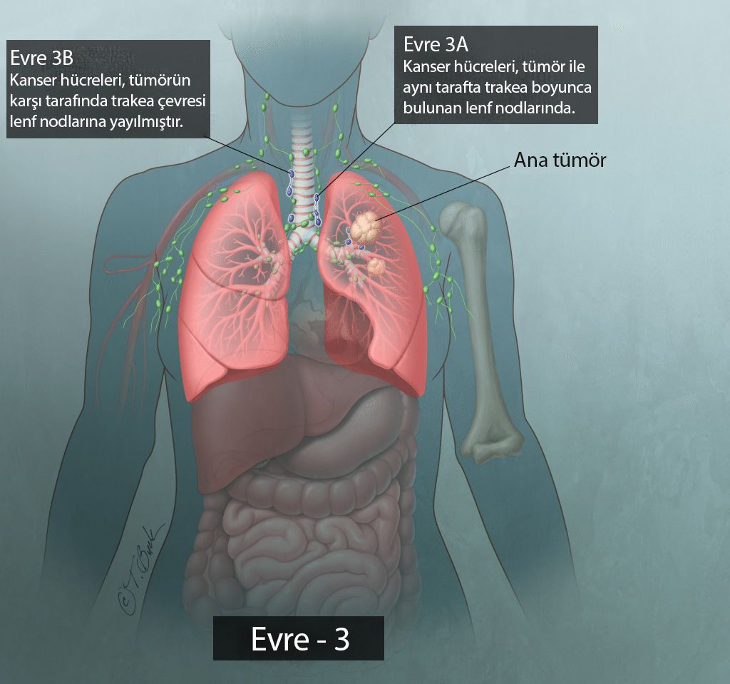 evre 3a 3b III akciğer kanseri küçük hücreli dışı