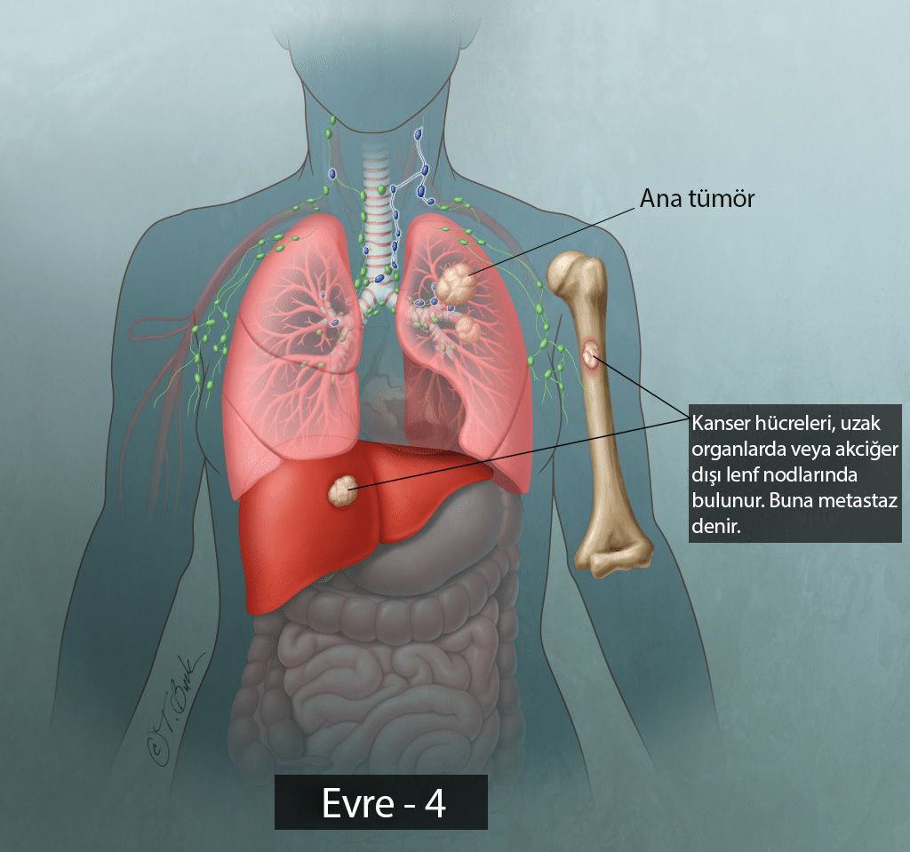 evre 4 metastatik akciğer kanseri