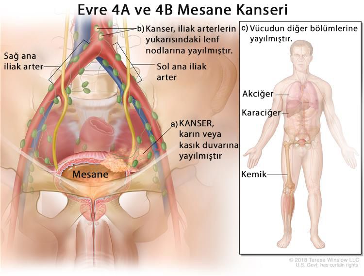 evre 4 metastatik mesane kanseri nedir