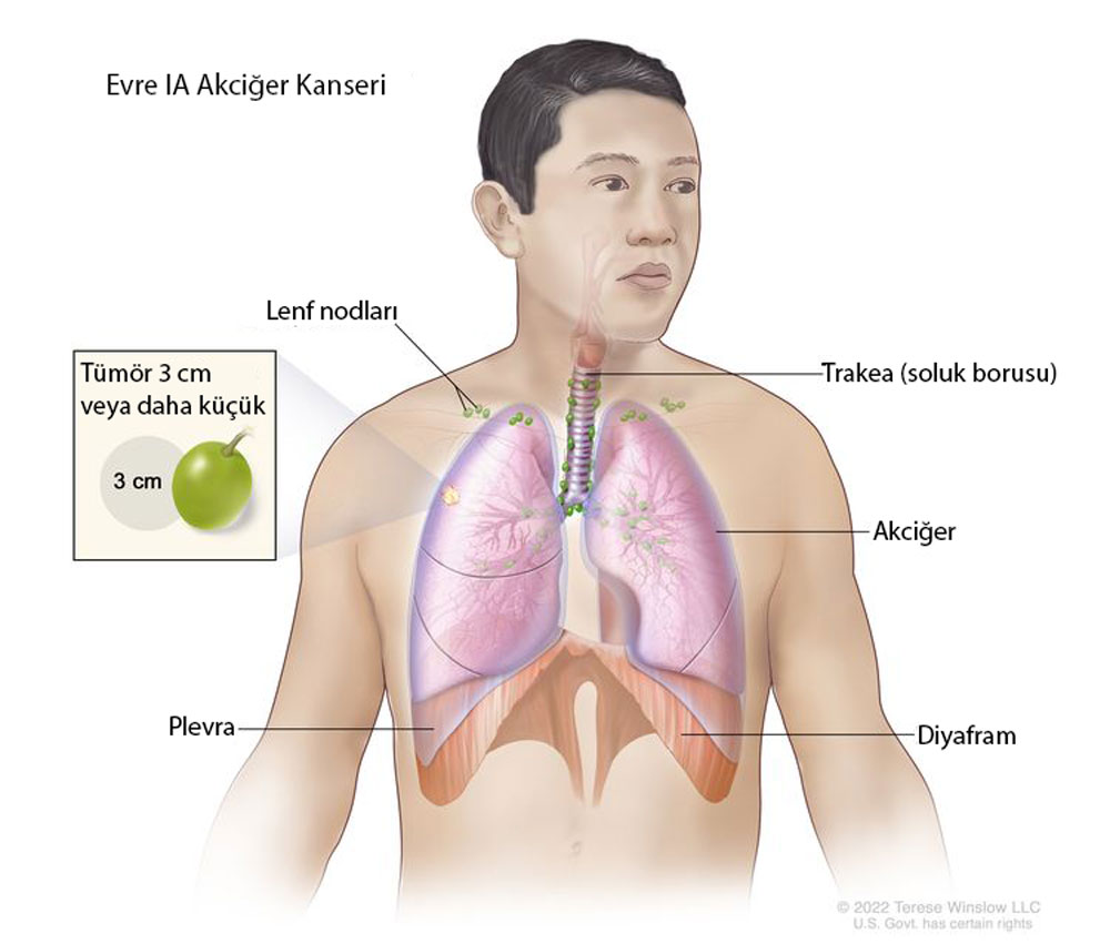 evre IA akciğer kanseri nedir