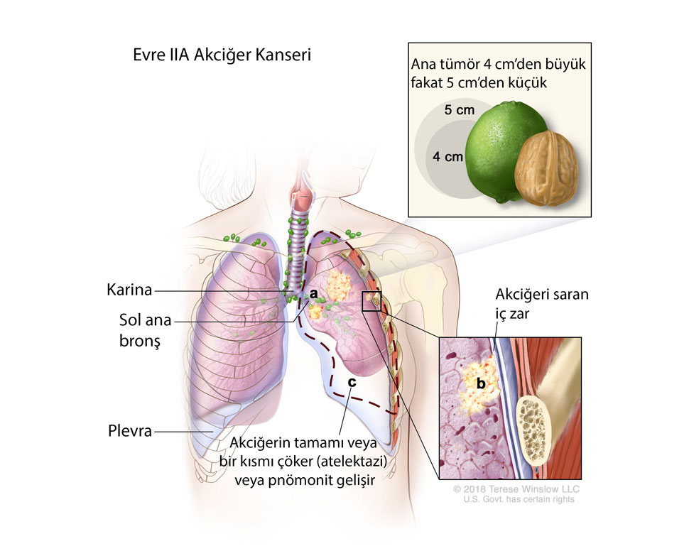 evre IIA akciğer kanseri nedir