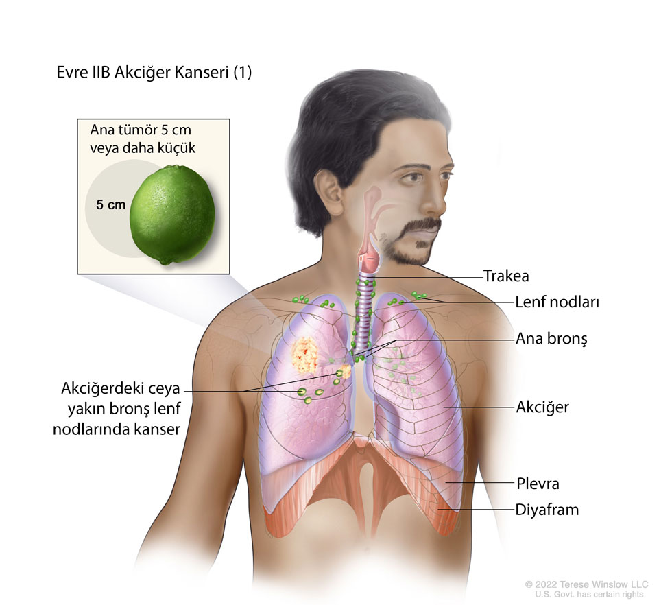 evre IIB akciğer kanseri nedir örnek 1