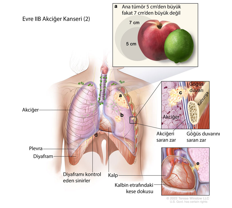 evre IIB akciğer kanseri örnek 2