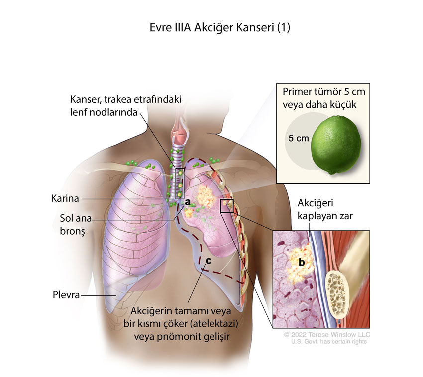 evre IIIA akciğer kanseri nedir örnek 1