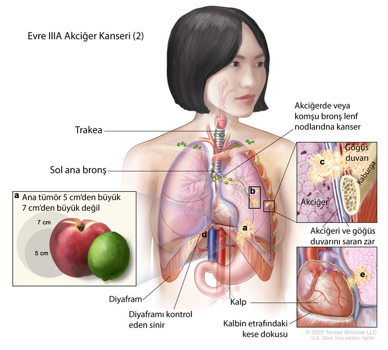 evre IIIA akciğer kanseri nedir örnek 2