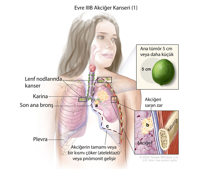 evre IIIB akciğer kanseri nedir örnek 1