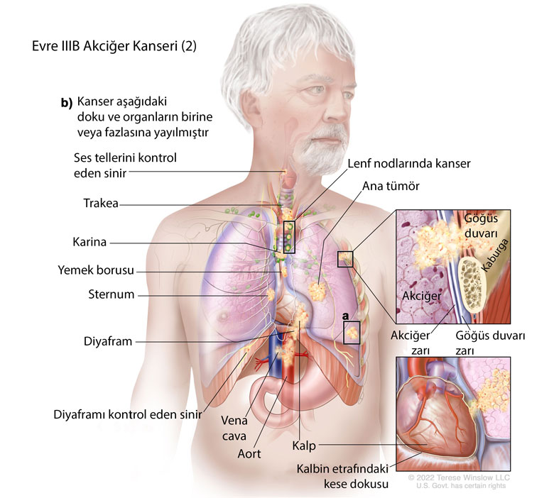 evre IIIB akciğer kanseri nedir örnek 2