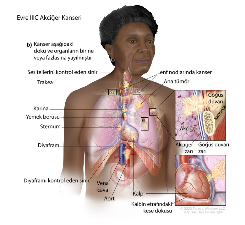 evre IIIC akciğer kanseri nedir