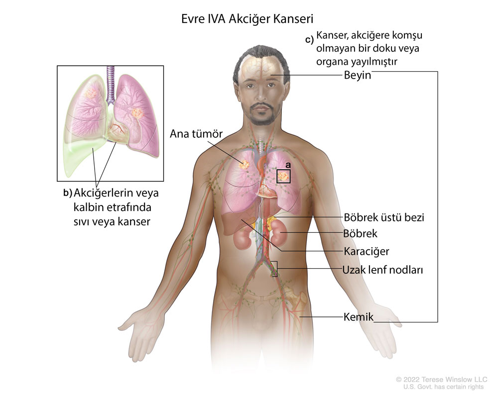 evre IVA akciğer kanseri nedir