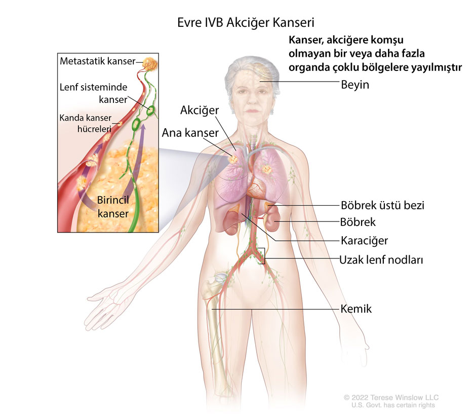 evre IVB akciğer kanseri nedir