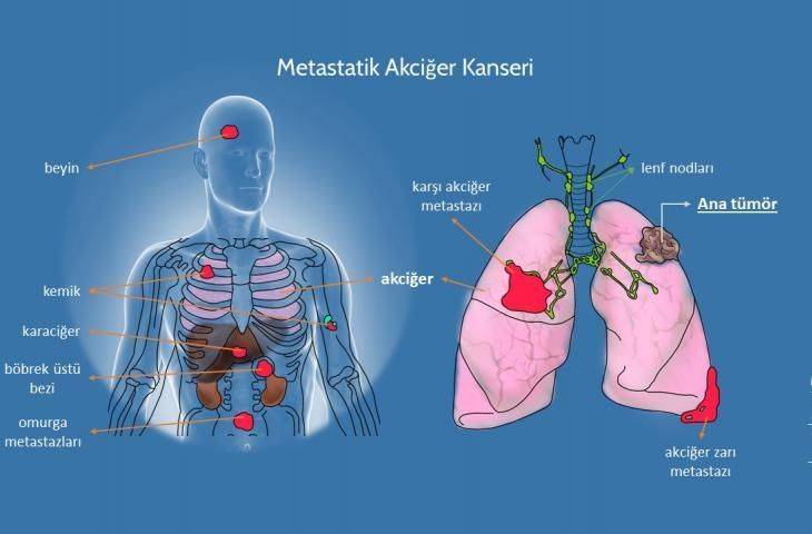 metastaz nedir metastaz belirtileri kanser neden metastaz yapar