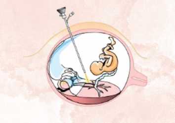 Fetal Cerrahi 1981 – Anne Karnındaki Bebeğin Ameliyat Edilmesi