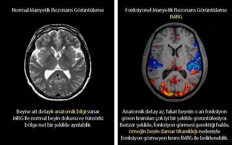 fonksiyonel MRG ve normanl manyetik rezonans karşılaştırması