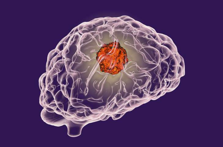 Beyin tümörü GBM’de immünoterapi etkinliğini değerlendiren en kapsamlı araştırmanın sonuçları