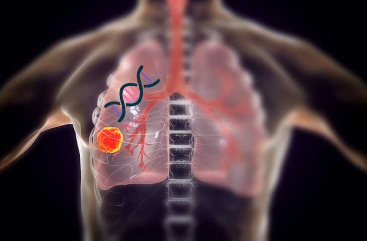 Genetik Altyapı, Sigara İçenlerin Akciğer Kanseri Riskini Belirliyor