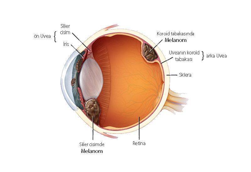 göz oküler uveal melanomu nerede yerleşir anatomisi