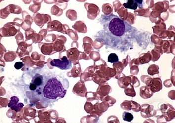 Hemofagositik lenfohistiyositoz tedavisi için Emapalumab FDA onayı aldı