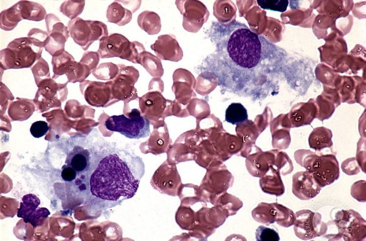 Hemofagositik lenfohistiyositoz tedavisi için Emapalumab FDA onayı aldı