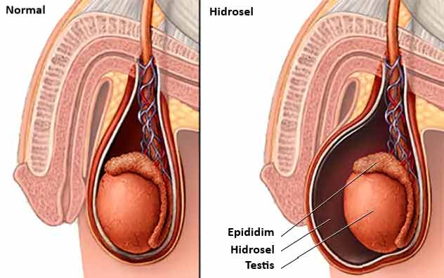 hidrosel nedir