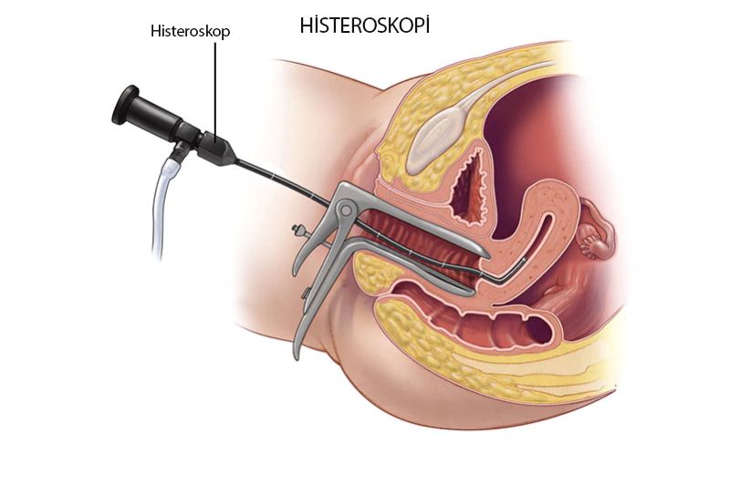 histeroskopi histeroskop nedir