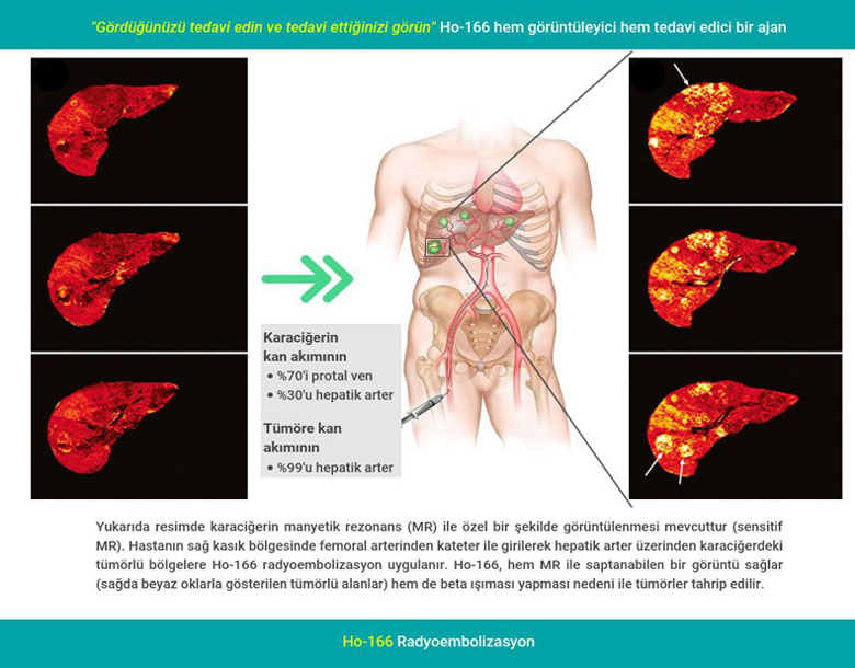 HO 166 hem goruntuleyici hem tedavi edici bir ajan