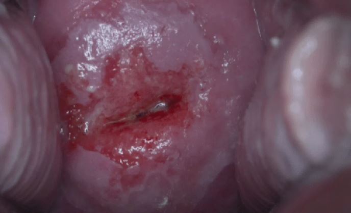 hpv infeksiyonlar nedir