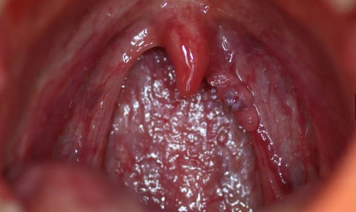 limken tapeworm does vestibular papillomatosis itchy