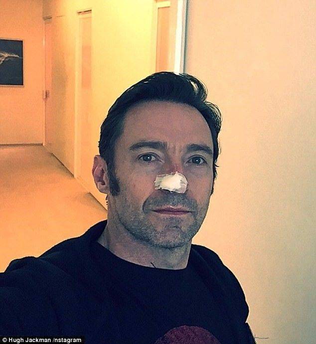 hugh jackman x men cilt kanseri mi bazal hücreli kanser