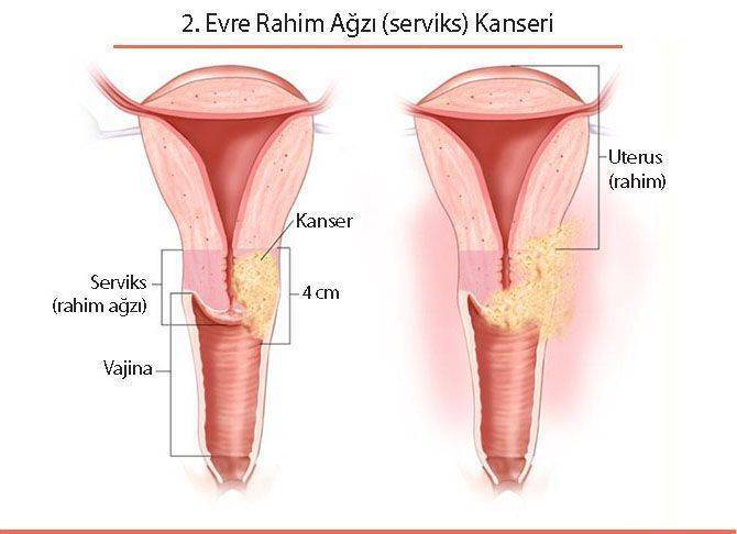 ikinci 2 evre rahim ağzı serviks kanseri