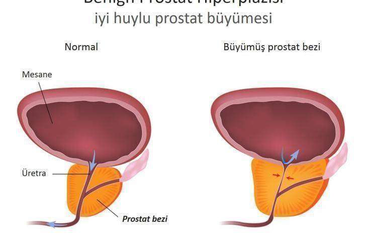 İyi huylu - benign prostat büyümesi – BPH
