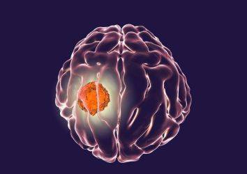 Kanser virüs aşısı ile beyin tümörü GBM tedavisinde görülmemiş bir başarı