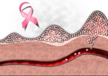 Kanserin Evresi Nedir? Tümörün Tedaviye Cevap Verdiği Nasıl Anlaşılır?