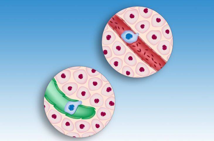 Kanserin Metastaz Yapmasını Baskılayıcı Bir Molekül Keşfedildi