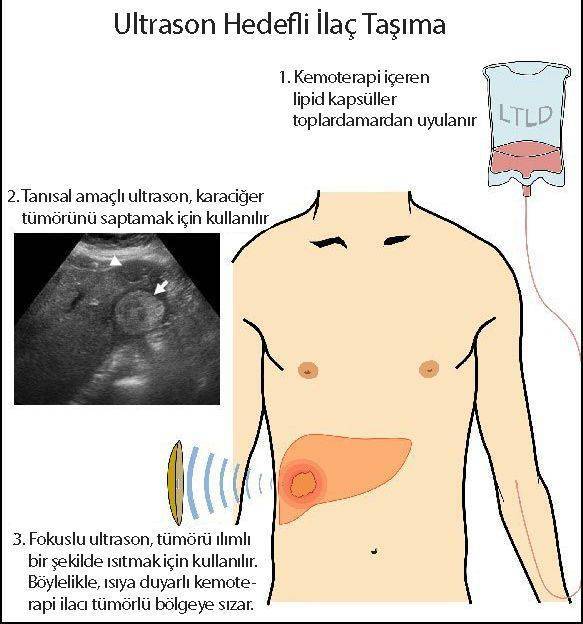 karaciğer tümörü kanseri tedavisi için yüksek yoğunluklu ultrason nasıl uygulanır TARDOX 