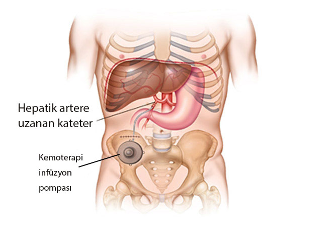Karaciğere hepatik arterden kemoterapi