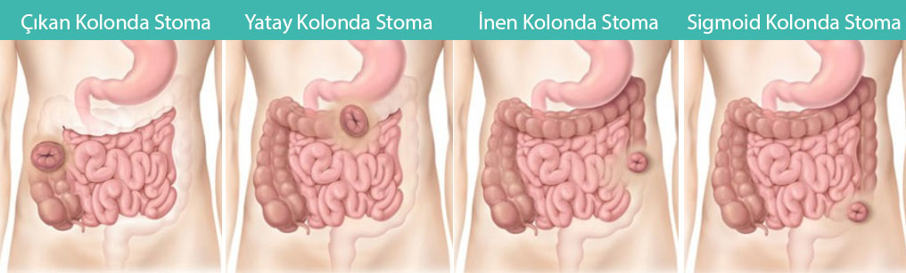 kolostomi çeşitleri çıkan transvers inen sigmoid stoma