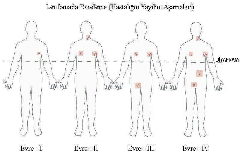 Lenfoma, Lenf Kanseri Nedir? Belirtileri ve Tedavisi nasıldır?