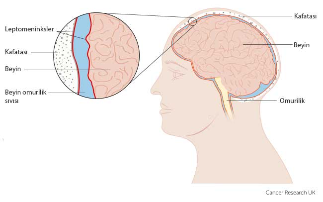 leptomeninks nedir leptomeningeal metastazı anlamak