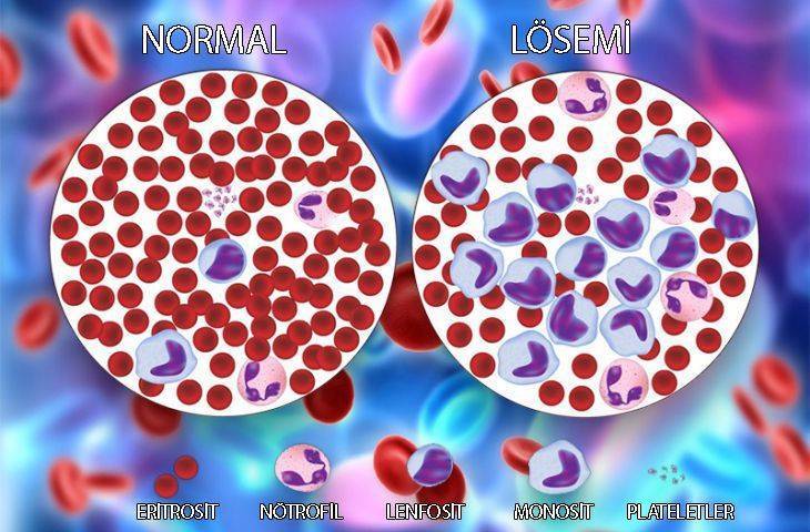 lösemi ve normal kan farkı