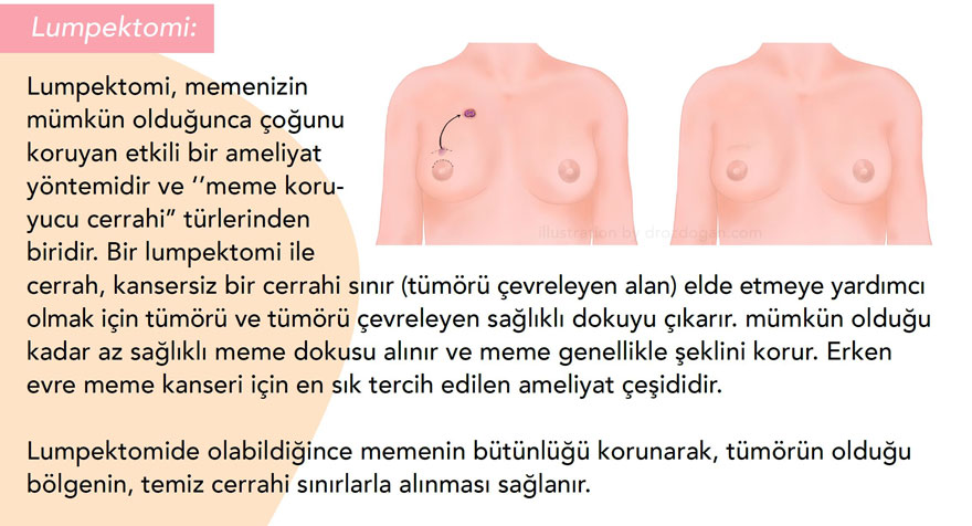 lumpektomi nedir