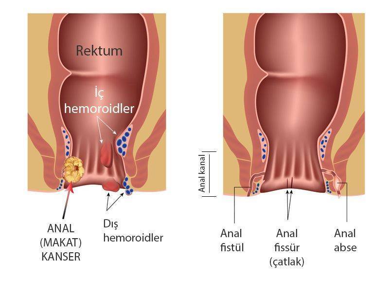 makat kanseri nedir ve diğer anal bozukluklar