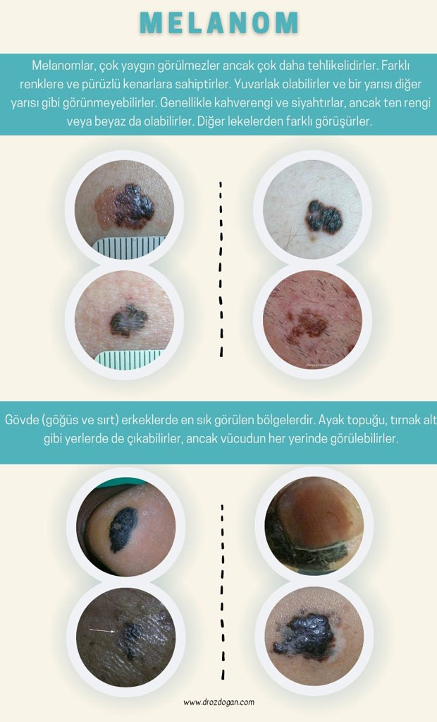 malign melanom cilt kanseri fotoğrafları