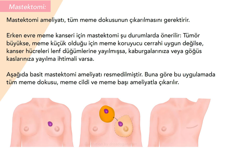 Mastektomi nedir
