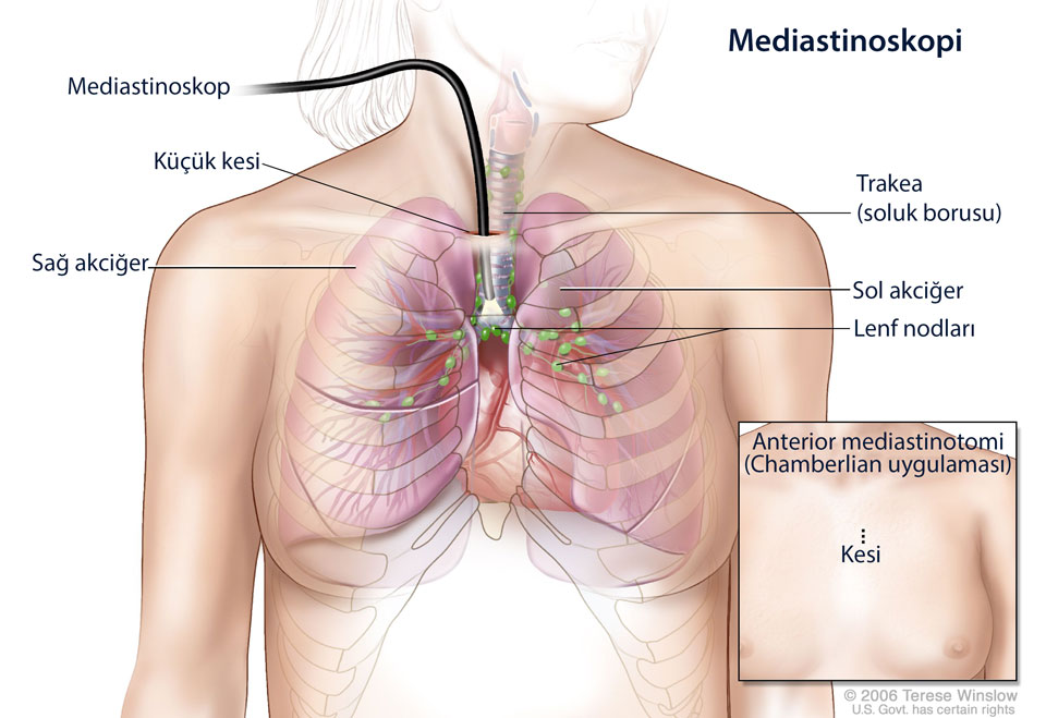 mediastinoskopi mediastinal lenf nodu orneklemesi nedir nasıl yapılır