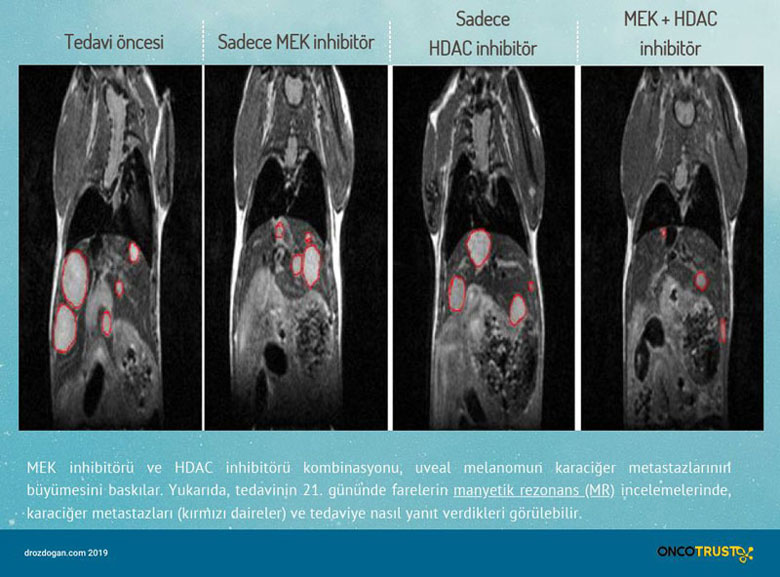 MEK inhibitörü HDAC inhibitörü