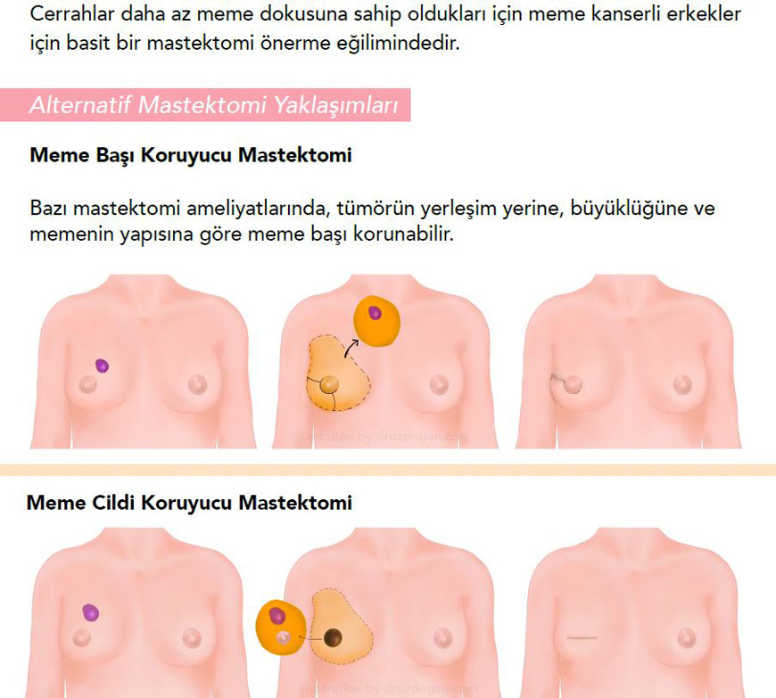 meme başı ve cildi koruyucu mastektomi nedir