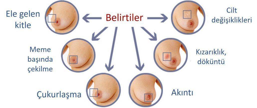 meme kanseri belirtileri nelerdir memede kitle